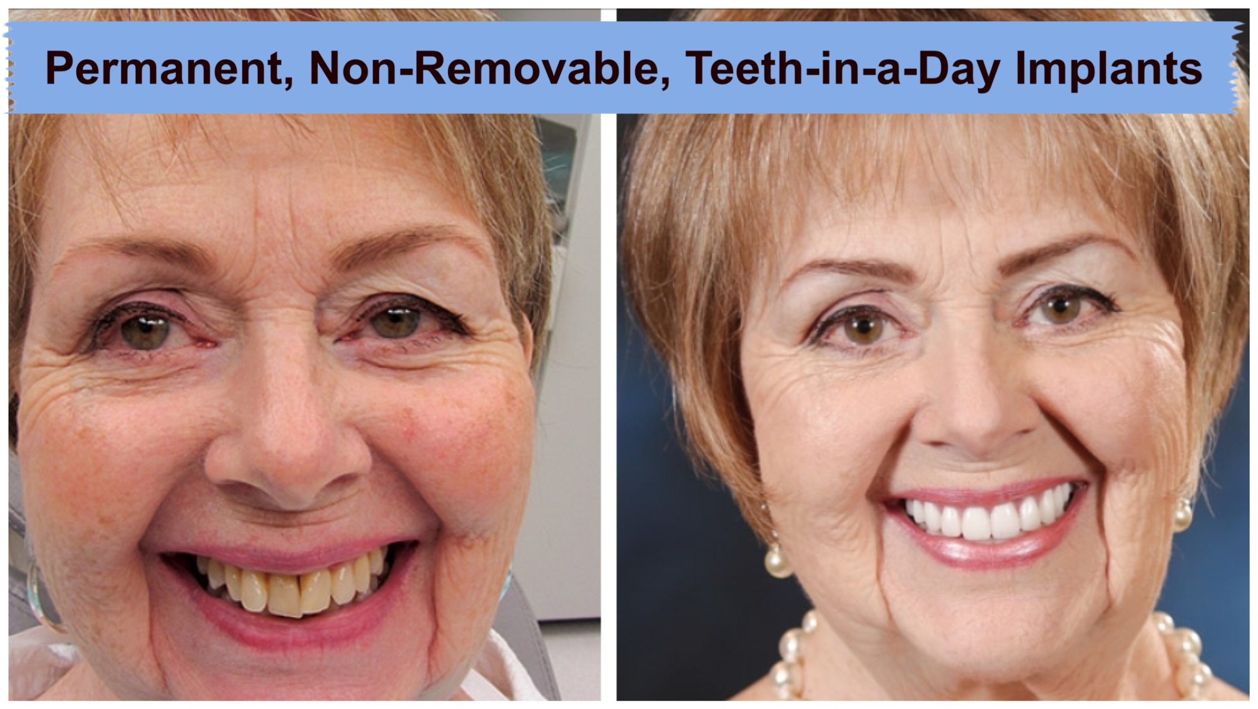 CeraRoot Zirconia Dental Implants