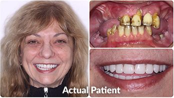 Dental Implants at Studio B Dental