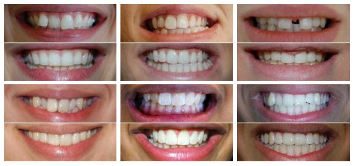 Invisalign Before and After