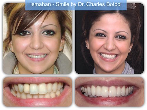 Ismahan - Smile by Dr. Charles Botbol