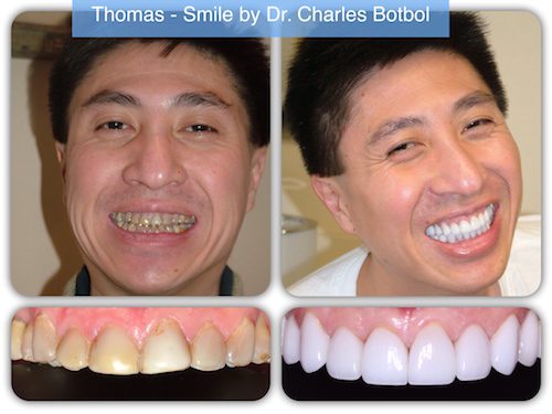 Thomas - Smile by Dr. Charles Botbol