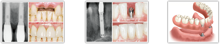 Toronto Dental Implants