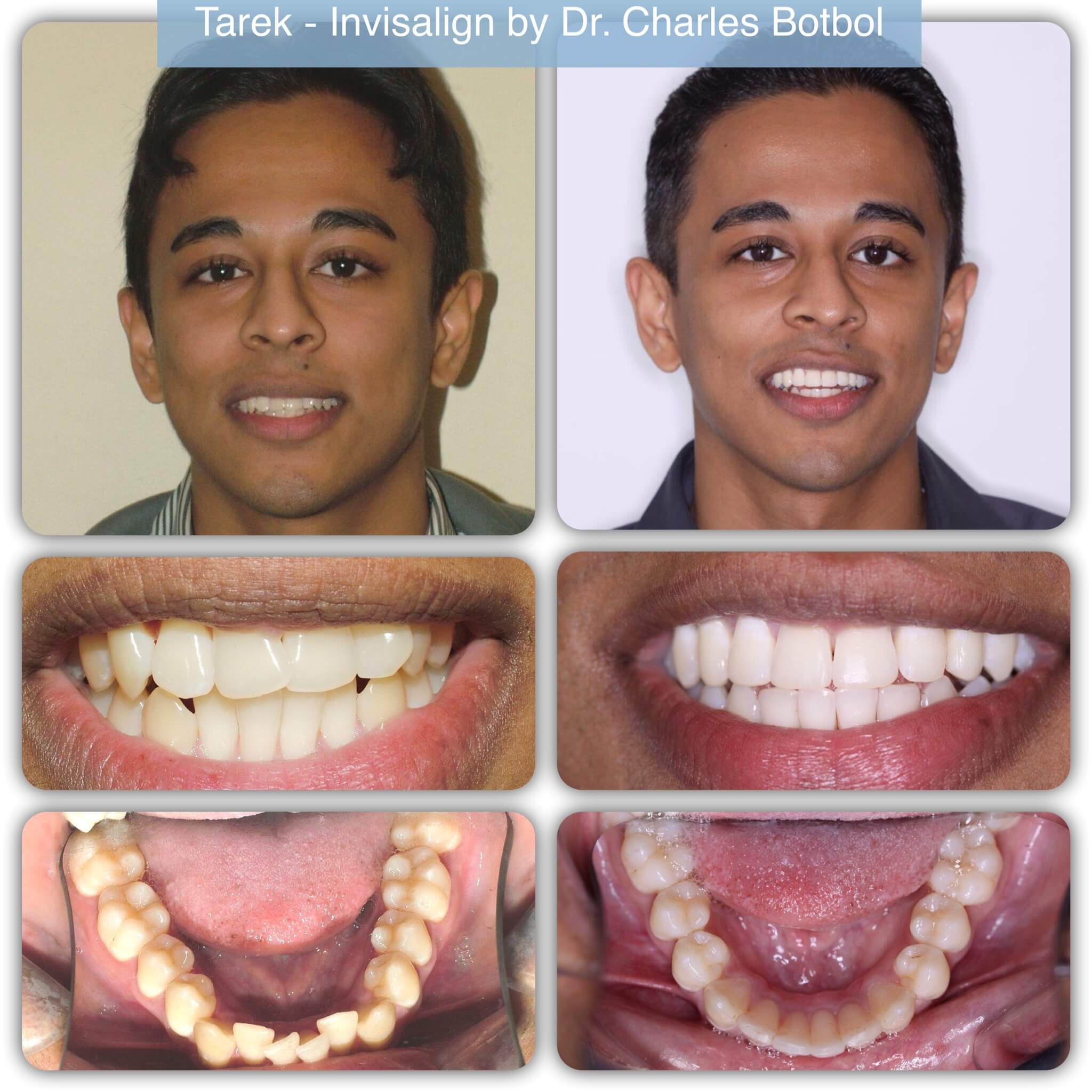 Why get Invisalign Invisible braces in Toronto