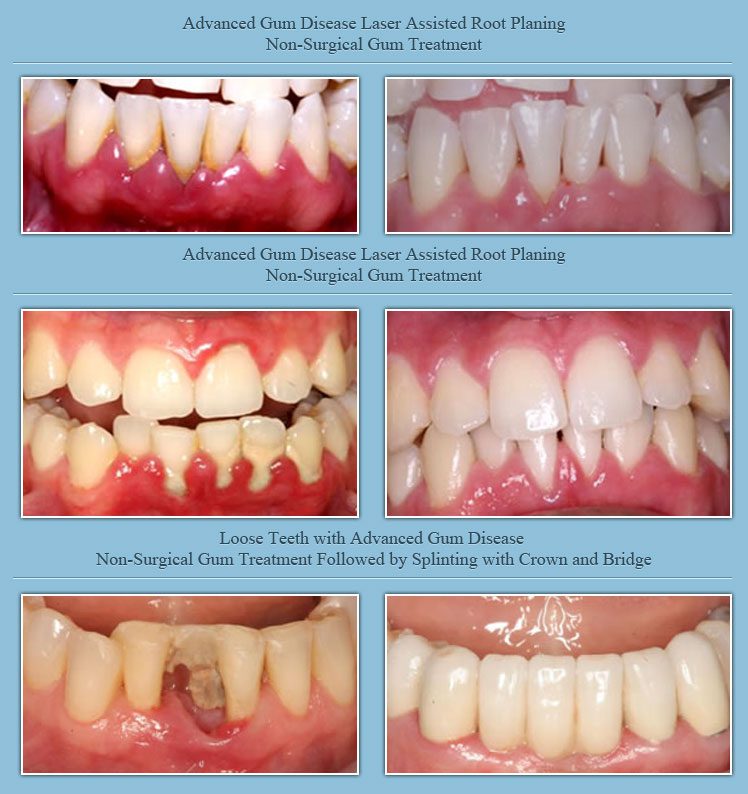 Non-Surgical Gum Therapy (Soft Tissue Management)