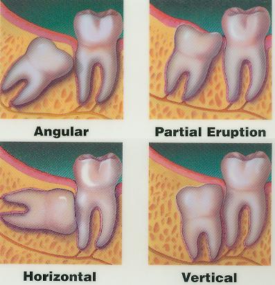 Wisdom Tooth Extraction