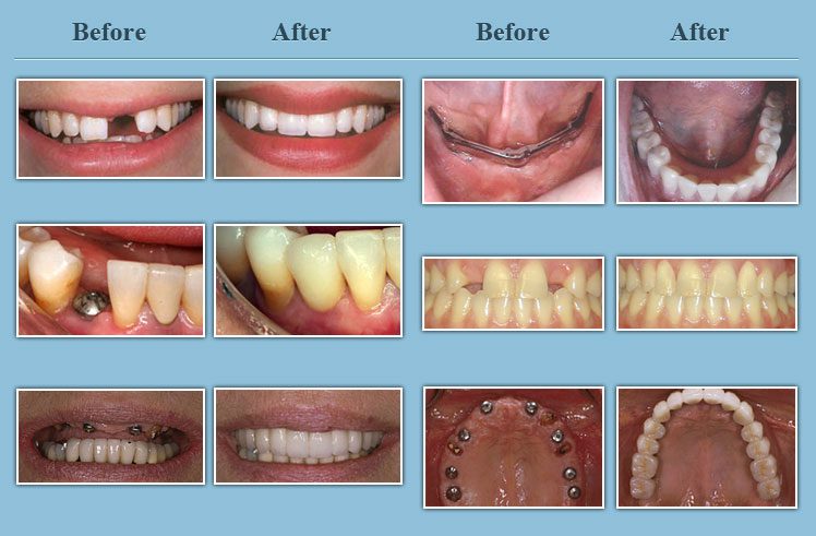 Dental Implants