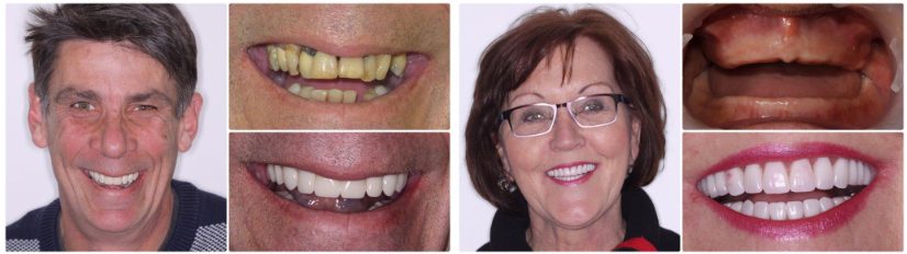 Dental Implants: Toronto Reviews Before-And-After