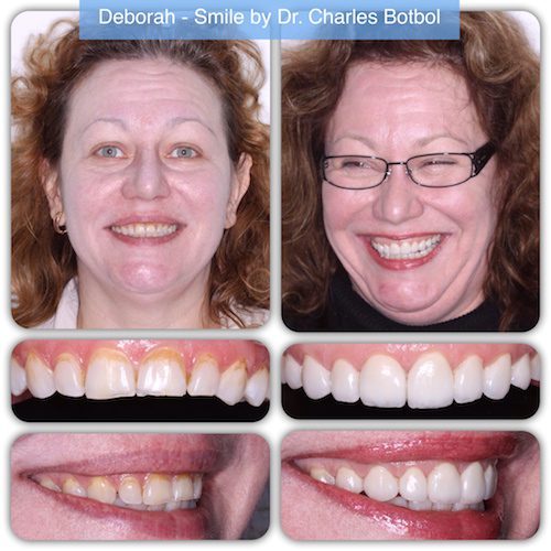 Deborah - Smile by Dr. Charles Botbol