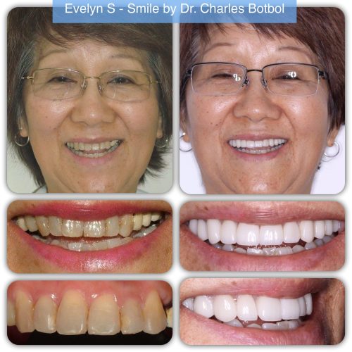 Evelyn S - Smile by Dr. Charles Botbol