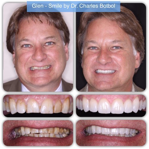 Glen- Smile by Dr. Charles Botbol