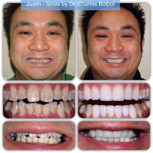 Justin - Smile by Dr. Charles Botbol