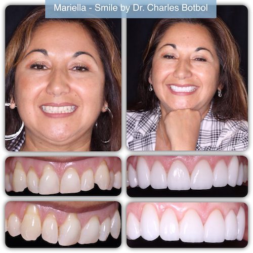 Mariella - Smile by Dr. Charles Botbol