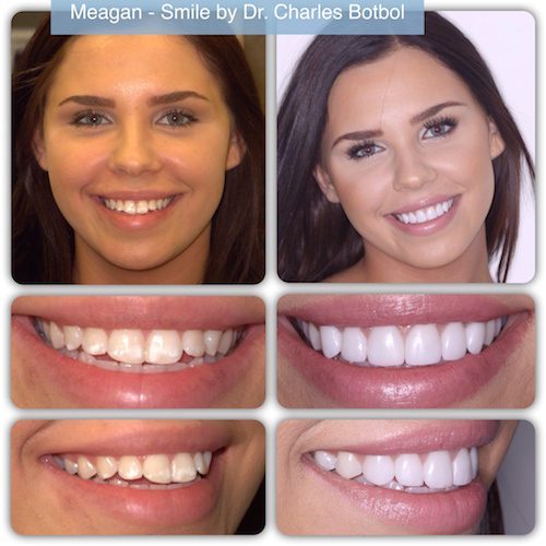 Meagan - Smile by Dr. Charles Botbol