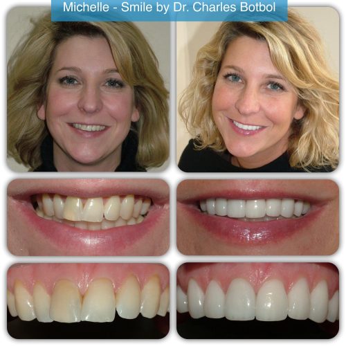 Michelle - Smile by Dr. Charles Botbol